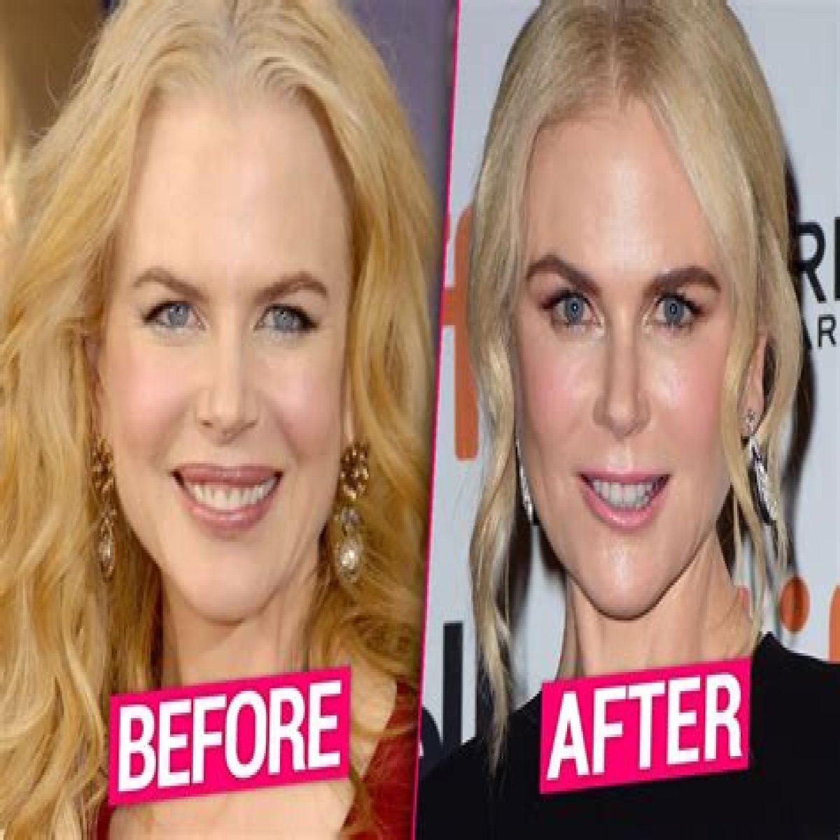 The Surprising Evolution Of Nicole Kidman's Look: Botox Or Natural Beauty?